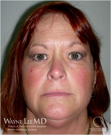 Eyelid Surgery (Blepharoplasty)