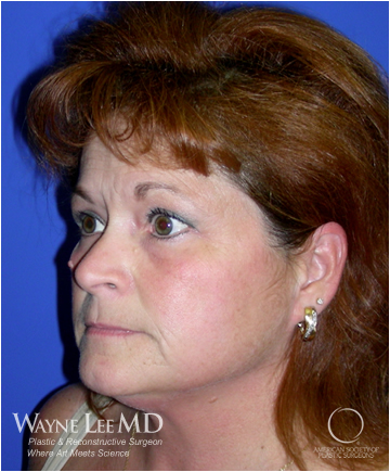 Eyelid Surgery (Blepharoplasty)