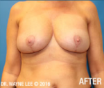 Mastopexy (Breast Lift)