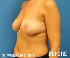 Mastopexy (Breast Lift)