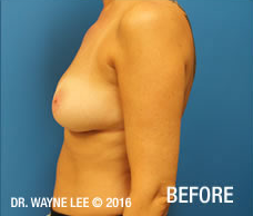 Mastopexy (Breast Lift)