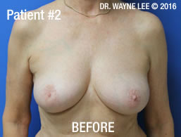 Mastopexy (Breast Lift)