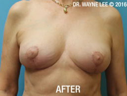 Mastopexy (Breast Lift)