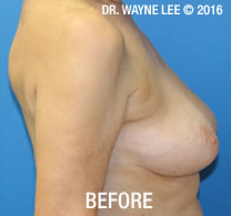 Mastopexy (Breast Lift)