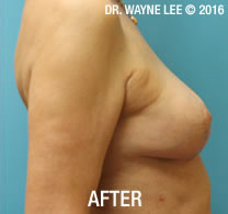 Mastopexy (Breast Lift)