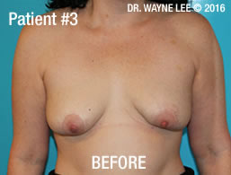 Mastopexy (Breast Lift)