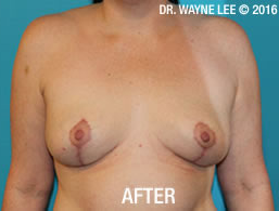 Mastopexy (Breast Lift)