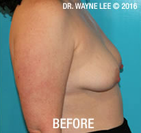 Mastopexy (Breast Lift)