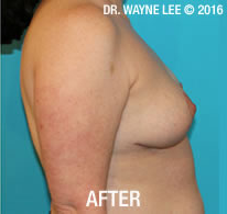 Mastopexy (Breast Lift)