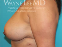 Breast Reduction