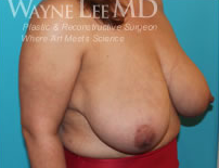 Breast Reduction