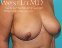 Breast Reduction