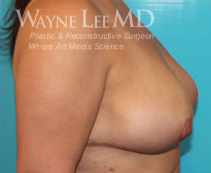 Breast Reduction