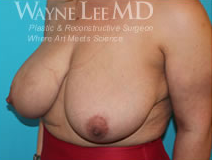 Breast Reduction