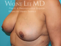 Breast Reduction