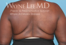 Breast Reduction