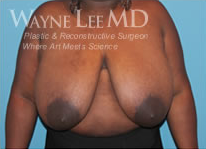 Breast Reduction