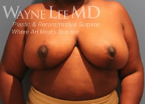 Breast Reduction