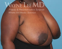 Breast Reduction