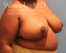 Breast Reduction