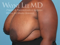 Breast Reduction