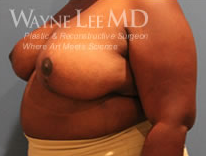 Breast Reduction