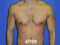 Gynecomastia