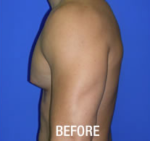 Gynecomastia