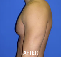 Gynecomastia