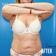 CoolSculpting