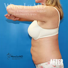 CoolSculpting