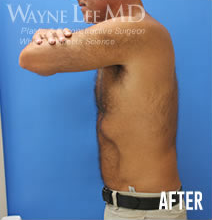 CoolSculpting