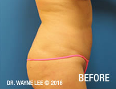 Cynosure-SmartLipo