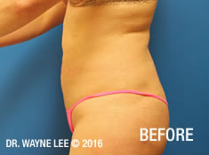 Cynosure-SmartLipo