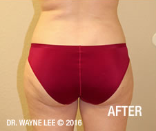 Cynosure-SmartLipo