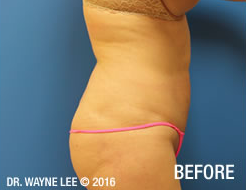 Cynosure-SmartLipo