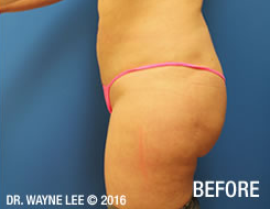 Cynosure-SmartLipo