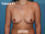 Breast Augmentation