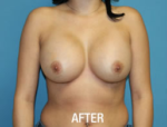 Breast Augmentation