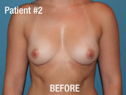 Breast Augmentation