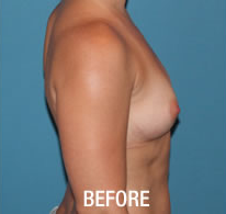 Breast Augmentation