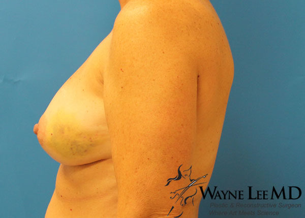 Breast Reconstruction