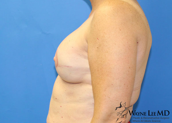 Breast Reconstruction