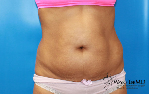 CoolSculpting