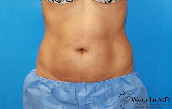 CoolSculpting