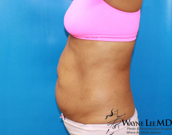 CoolSculpting