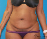 Tummy Tuck