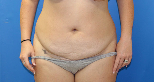 Tummy Tuck