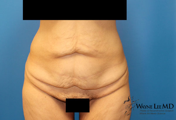 Tummy Tuck