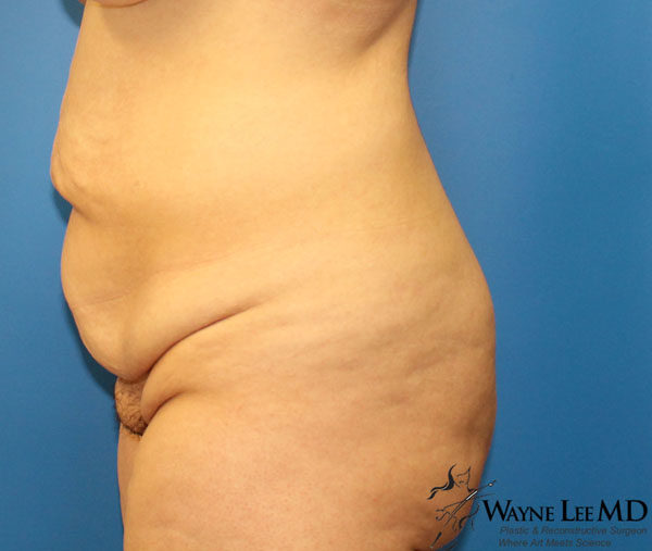 Tummy Tuck